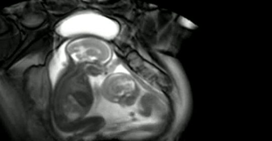 La Resonancia Magnética Fetal una prueba inofensiva para el feto