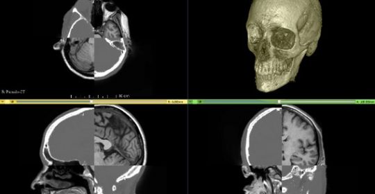 La Revolución de la Resonancia Magnética para Visualizar el Cráneo