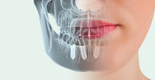 El Dentascan y la odontología computarizada 3D