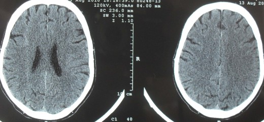 El TAC Cerebral y como intrerpretarlo