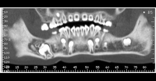 ¿Qué es un Dentascan?