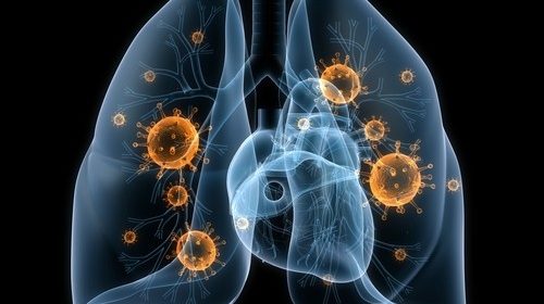 Cáncer de pulmón, una nueva prueba nasal puede ser determinante.