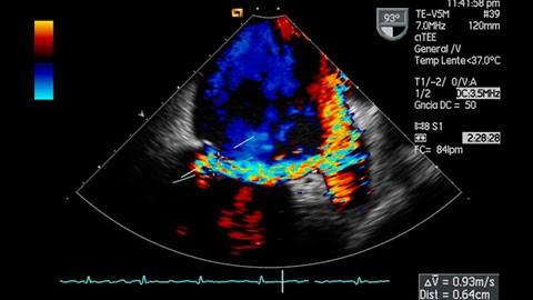 La ecocardiografía , la tecncología que permite ver el corazón.