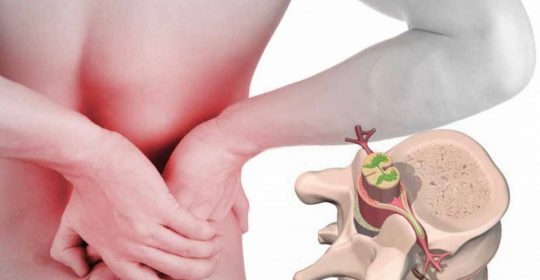 ¿Cómo se diagnostica la hernia discal dorsal o torácica?