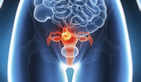 La Resonancia Magnética permite eliminar miomas sin cirugía ni anestesia.