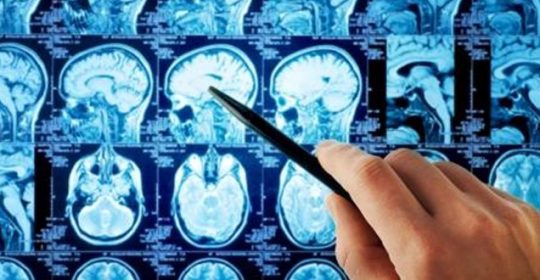 La neurología cuenta con un nuevo aliado, una nueva resonancia magnética es capaz de captar las lesiones de difícil diagnóstico.