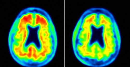 El deterioro cognitivo del alzheimer es frenado por un farmaco en pruebas llamado Aducanumab.