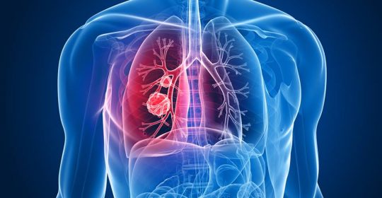 La detección precoz del cancer de pulmón aumenta la supervivencia al 80%