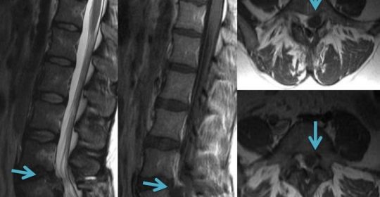 La resonancia magnética lumbar