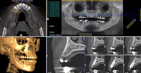 La importancia del DENTA-SCAN antes de realizarse un implante dental