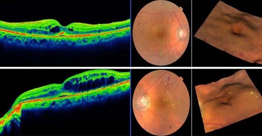 El OCT como herramienta imprescindible para el diagnóstico del glaucoma.