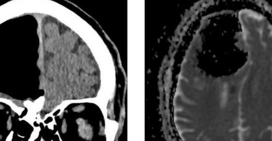 Descubren un agujero en el cerebro de un paciente gracias a un TAC Cerebral
