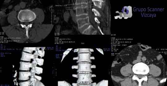 TAC lumbar