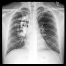 El 80% de los diagnósticos de cáncer de pulmón, se detectan tarde