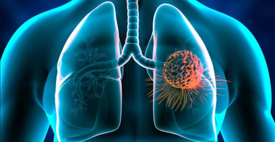 El 80% de los diagnósticos de cáncer de pulmón, se detectan tarde