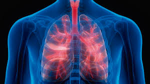 cánceres pulmonares