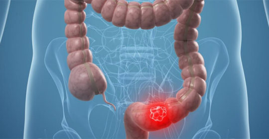 Detección del cáncer de colon