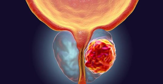¿Cuál es la mejor técnica para la valoración y seguimiento del cáncer de próstata?