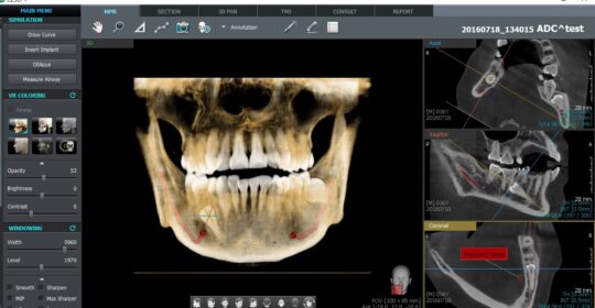 La importancia del TAC dental en odontología