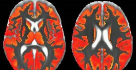 La Resonancia Magnética permite ver en vivo la inflamación cerebral