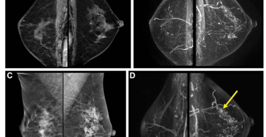 La eficacia de la resonancia magnética mamaria en la detección del cáncer de mama en tejido denso