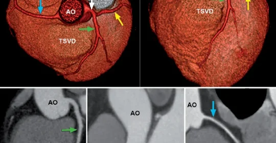 El ejercicio regular en la prevención de enfermedades cardiovasculares