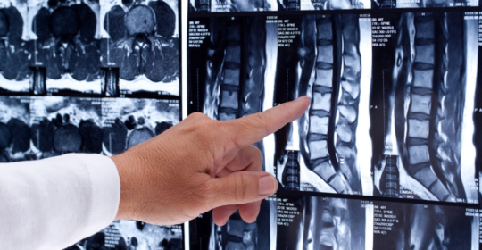 Resonancia Magnética Lumbar: Diagnóstico preciso y no invasivo de las afecciones de la columna vertebral