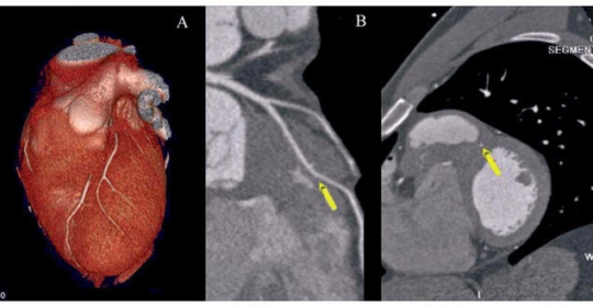 Descifrando el Corazón gracias al TAC Cardiaco