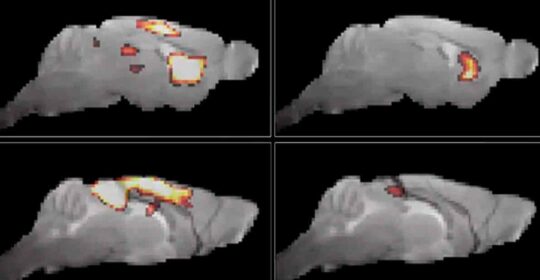 Alteraciones cerebrales tempranas podrían indicar riesgo conjunto de depresión y Parkinson